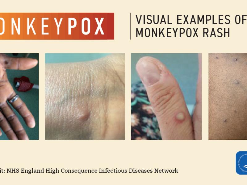 Visual examples of monkeypox rash from the CDC